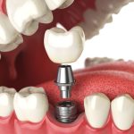 what does a tooth implant look like