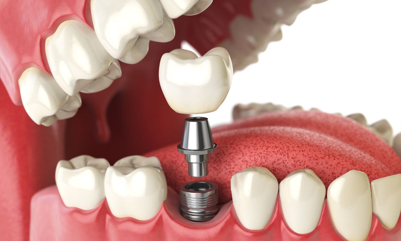 what does a tooth implant look like