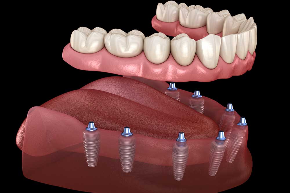 What to Do If You Can't Afford Dental Implants